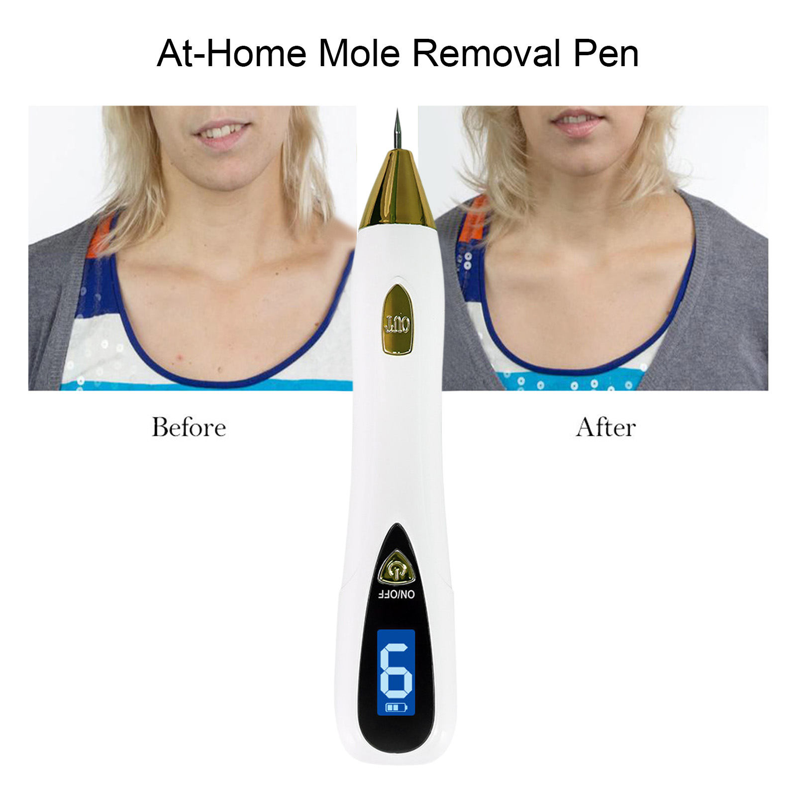 أداة إزالة الشامات والثآليل ال - مراجعة Plasma Mole Spot Removal Pen 9 Level وسعره